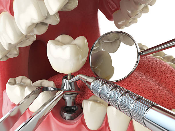 Best Emergency Dentist for Lost Fillings or Crowns in Governors Clu, NC